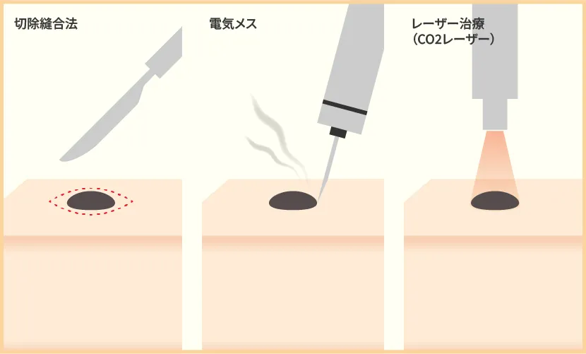 治療方法のイラスト