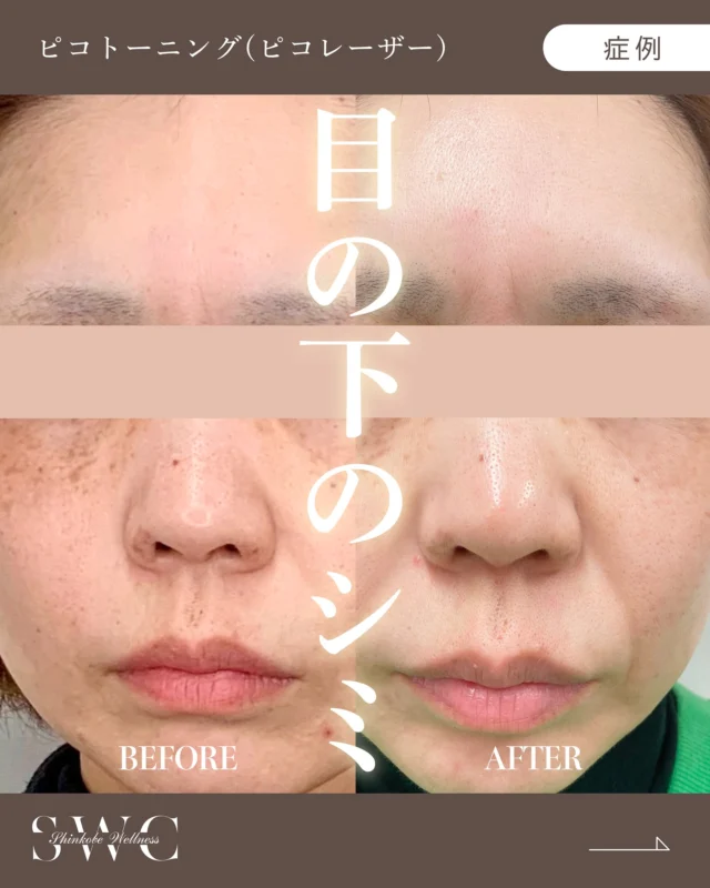 .
🌿新神戸ウェルネスクリニック美容皮膚科です🌿

今回は "ピコトーニング"の症例 をご紹介します✨

【40代】
お悩み：両目下の大きなくすみとシミ、鼻のシミ、目の下の肝斑が気になる

定期的にピコトーニングを10回施術。
さらにシナール・ユベラ・トラネキサム酸の内服を併用！
肌の内側・外側の両面からアプローチしたことで、お肌全体がなめらかに整い、明るく透明感のある印象へと変化しました✨

📸 治療前 → 10回施術後 の経過をご覧ください😊

【施術リスク】
◯腫れや赤み：1～3日で落ち着いてきます。
○点状出血：1～2週間で症状が消失します。
○色素脱失：稀に起こることがあります。

⚠️症例写真は施術による変化の一例であり、
すべての方に同様の効果を保証するものではありません。

※ピコトーニングは、低出力のレーザーをシャワーのように広範囲に繰り返し照射することで、皮膚のメラニン色素を少しずつ減らしていく治療法です。お顔全体のシミや肝斑、くすみ治療に向いており、回数を重ねることでお顔全体がトーンアップしていきます。
詳しくはプロフィール下のHPよりご確認ください。

まずは無料カウンセリングでお気軽にご相談ください💐

＿＿＿＿＿＿＿＿＿＿＿＿＿＿＿＿＿＿

神戸市中央区北野1-1 コトノハコ神戸1F
☎︎ 078-272-0711
市営地下鉄 新神戸駅 南改札口 徒歩1分
営業時間 9:00〜19:00（電話受付 9:00〜17:00）
ANAクラウンプラザホテル神戸 駐車場ご利用可能🚗
＿＿＿＿＿＿＿＿＿＿＿＿＿＿＿＿＿＿

#ピコレーザー #ピコトーニング #肌質改善 #トーンアップ #神戸美容クリニック