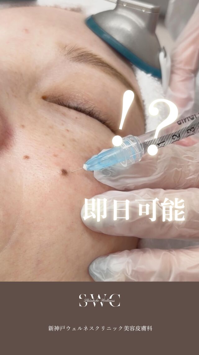 .
🌿新神戸ウェルネスクリニック美容皮膚科です🌿

✨【ほくろ・イボ除去】をもっと身近に✨
CO2レーザー治療の魅力☝️🌟

当院では、CO2レーザーを使用した“即日除去”が可能なほくろ・イボ治療を行っています。

✔︎ 1回で除去できる
CO2レーザーで焼灼しながら削り取るため出血もほぼなし。3mm以下なら1回の施術で完了します。（深い病変は安全を考慮して複数回に分けて施術する事があります）

✔︎ 短時間でサッと照射
高性能「UAL3000DP」で、必要な部分へピンポイント照射。照射時間が短く、仕上がりもきれいなのが特徴です。

✔︎ 周囲の肌ダメージを最小限に
超短時間（マイクロ秒）でOn/Offを繰り返すため、周囲の熱損傷を抑えながら、ほくろ・イボのみを的確に蒸散させます。
＿＿＿＿＿＿＿＿＿＿＿＿＿＿

🩺 施術の流れ

① 診察
医師が既往歴•ホクロとイボの状態を確認し、CO2レーザーの仕組みやリスクなどを丁寧に説明します。

② 局所麻酔
大きめのほくろなど必要に応じて麻酔を使用。

③ レーザー照射
CO2レーザーで切除。
(※局所麻酔のチクッとした痛みだけで切除することが出来ます。)

④ 軟膏＋テープ保護
照射部位に軟膏を塗り、肌に優しいテープで保護します。

⑤ アフターケア
5日間の軟膏塗布と2週間はテープ保護を継続。紫外線対策はしっかりお願いします。

⑥再診(2週間後)
経過を確認します。
＿＿＿＿＿＿＿＿＿＿＿＿＿＿

📌こんな人におすすめ‼︎
◉顔に気になるほくろがある方
◉イボがたくさんあって取りたい方
◉盛り上がったシミが気になる方

⚠️ほくろの種類や大きさ、状態によっては切除できない場合もあります。

気になる方は無料カウセリングで是非ご相談ください💐

＿＿＿＿＿＿＿＿＿＿＿＿＿＿＿＿＿＿

神戸市中央区北野1-1 コトノハコ神戸1F
☎︎ 078-272-0711
市営地下鉄 新神戸駅 南改札口 徒歩1分
営業時間 9:00〜19:00（電話受付 9:00〜17:00）
ANAクラウンプラザホテル神戸 駐車場ご利用可能🚗
＿＿＿＿＿＿＿＿＿＿＿＿＿＿＿＿＿＿

＃ほくろ＃ほくろ取り＃ほくろ除去＃CO2レーザー
