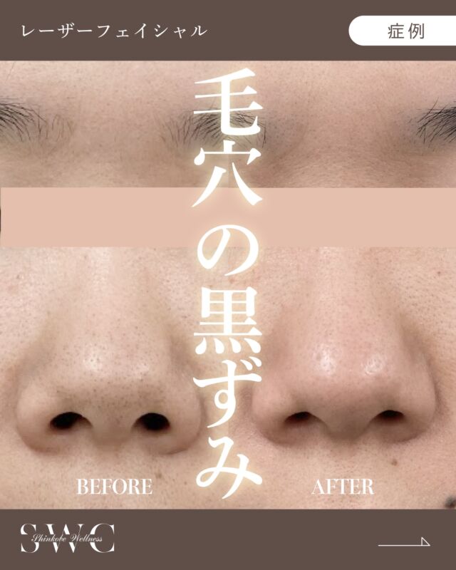 .
🌿新神戸ウェルネスクリニック美容皮膚科です🌿

今回は "レーザーフェイシャル"の症例 をご紹介します✨

【20代 女性】

お悩み：ニキビ跡、毛穴、黒ずみ

レーザーフェイシャルを定期的に継続することで、気になっていた毛穴がキュッと引き締まり、ザラついていたお肌もつるんとなめらかに💎✨
肌質そのものが整い、ファンデーションに頼らない明るい素肌を取り戻しました✨

📸 治療前 → 10回施術後 の経過をご覧ください😊

【施術リスク】
●腫れや赤み：1～3日で落ち着いてきます。
●点状出血：1～2週間で症状が消失します。
●色素脱失：稀に起こることがあります。

⚠️症例写真は施術による変化の一例であり、
すべての方に同様の効果を保証するものではありません。

※レーザーフェイシャルとは、メラニン色素に働きかけることで、色素沈着が原因の肌トラブルへ効果をもたらすことができます。
他にも脱毛や毛穴の引き締め、ニキビ改善などにも効果があります。
レーザーフェイシャルには、「アレキサンドライトレーザー」と呼ばれる光を照射します。
照射と同時に冷却ガスを使うため痛みが軽減されます。

気になった方はまずは無料カウンセリングでお気軽にご相談ください💐

＿＿＿＿＿＿＿＿＿＿＿＿＿＿＿＿＿＿

神戸市中央区北野1-1 コトノハコ神戸1F
☎︎ 078-272-0711
市営地下鉄 新神戸駅 南改札口 徒歩1分
営業時間 9:00〜19:00（電話受付 9:00〜17:00）
ANAクラウンプラザホテル神戸 駐車場ご利用可能🚗
＿＿＿＿＿＿＿＿＿＿＿＿＿＿＿＿＿＿

#ニキビ跡 #毛穴 #黒ずみ #シワ #レーザーフェイシャル