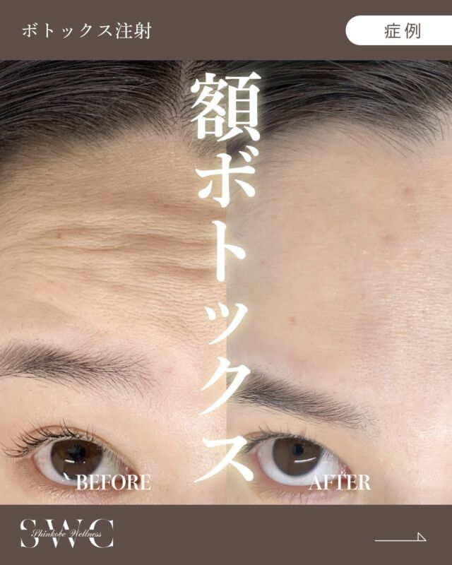 .
🌿新神戸ウェルネスクリニック美容皮膚科です🌿

今回は "ボトックス注射"の症例 をご紹介します✨

【30代 女性】

お悩み：おでこのシワが気になる

額にボトックス注射を施術。
表情筋の過剰な働きを抑えることで、額の溝の深いシワがなくなり、額の印象が明るく若々しい雰囲気になりました。✨

📸 治療前 → ２週間後 の経過をご覧ください😊

【施術リスク】
◯腫れや赤み：注射による物理的な反応で、通常は数日で自然に治まります。
◯内出血 : 自然に症状は消失します。

⚠️症例写真は施術による変化の一例であり、
すべての方に同様の効果を保証するものではありません。

※ボトックスとは、ボツリヌス毒素から抽出されたタンパク質の成分を使用した“薬剤“です。
気になる部位に注入することで余計な筋肉の動きを止めます。
その結果、シワの改善やエラの咬筋の縮小、汗腺の働きを抑えることで汗を減らすなど様々な効果を得られることができます。
ボトックス注射は、上手に使えば多くの美容効果を生むことができる、非常に便利でオススメな美容治療です。
1回の注射で効果は2週間程度で現れ、およそ3～6ヵ月維持します。
効果が薄らいできたら再度注射します。国内では重い副作用は報告されていないという、安全で非常に効果のある美容医療方法の１つです。

気になった方はまずは無料カウンセリングでお気軽にご相談ください💐

＿＿＿＿＿＿＿＿＿＿＿＿＿＿＿＿＿＿

神戸市中央区北野1-1 コトノハコ神戸1F
☎︎ 078-272-0711
市営地下鉄 新神戸駅 南改札口 徒歩1分
営業時間 9:00〜19:00（電話受付 9:00〜17:00）
ANAクラウンプラザホテル神戸 駐車場ご利用可能🚗
＿＿＿＿＿＿＿＿＿＿＿＿＿＿＿＿＿＿

#シワ #ボトックス #額ボト #シワ改善 #関西美容クリニック
