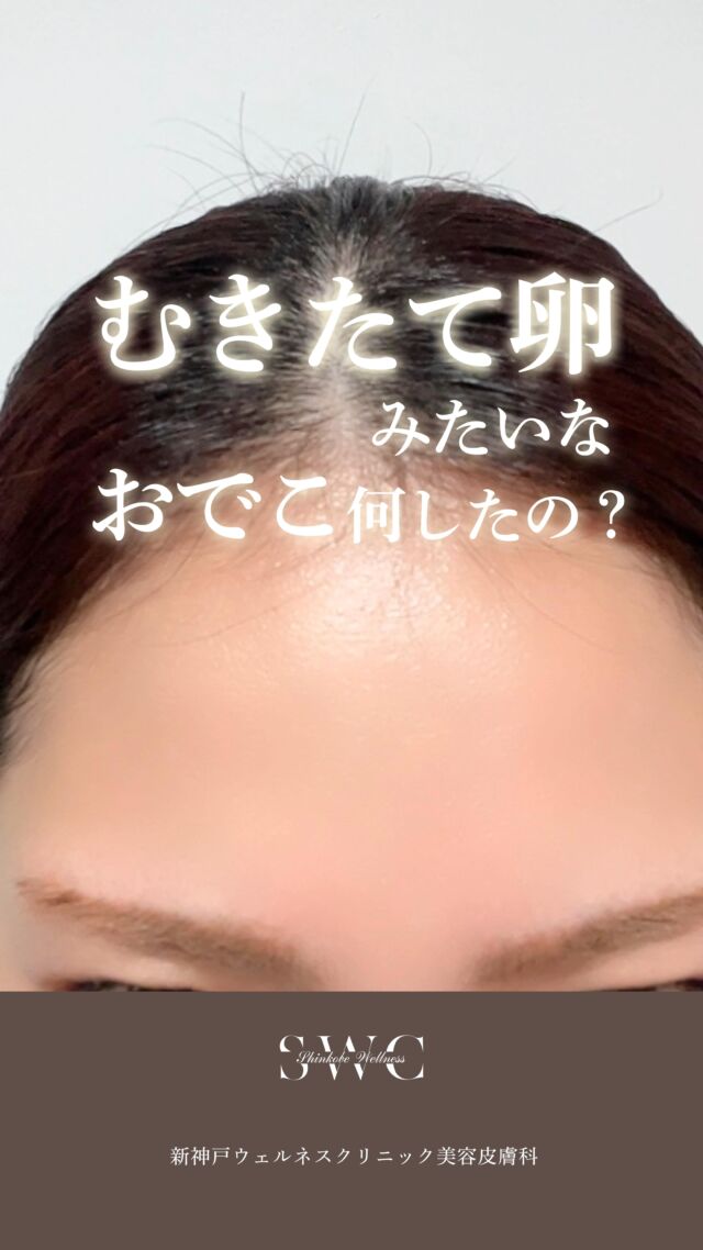 .
\\✨ボトックス注射のご紹介✨//

シワ・エラ張り・発汗のお悩みに。
当院では、安全性の高い"メディトックス社製「イノトックス」"を使用しています。

💉ボトックスとは？
筋肉の過剰な動きを抑えることで
✔ 表情ジワの改善（額・眉間・目尻）
✔ 小顔効果（エラの張り）
✔ ワキ汗・においの軽減
などに効果を発揮します。

🧪 使用薬剤の特徴
・液状タイプで希釈不要 → 濃度のばらつき・感染リスクを軽減
・ヒト血清アルブミン不使用 → アレルギーや副作用リスクを抑制
・韓国KFDA承認済み → 安全性と有効性が証明済み

⏳ 効果の目安
・2〜14日で効果を実感
・持続期間は3〜6ヶ月程度

まずは無料カウセリングでお気軽にご相談ください✨

___________________________________

神戸市中央区北野1-1コトノハコ神戸1F
☎︎ 2078-272-0711
市営地下鉄新神戸駅南改札口 徒歩1分
営業時間 9:00-19:00（電話受付9:00-17:00）
ANAクラウンプラザホテル神戸の駐車場ご利用可能
___________________________________

#肌質改善#美容医療#ボトックス#美容クリニック#美肌