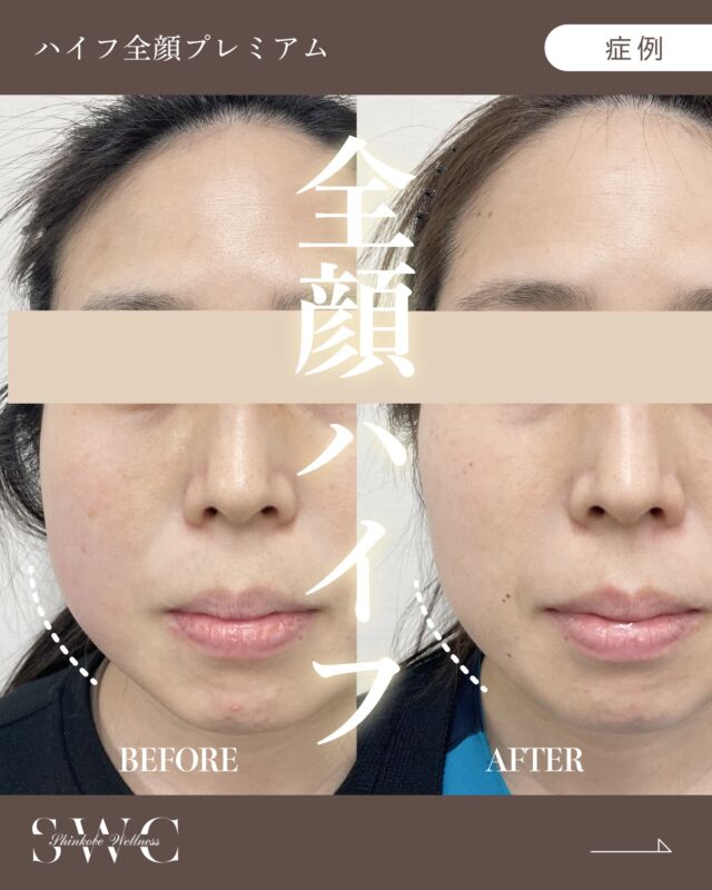 .
🌿新神戸ウェルネスクリニック美容皮膚科です🌿

今回は "全顔ハイフ"の症例 をご紹介します✨

【30代 女性】

お悩み：お顔全体のたるみ

📸 治療前 → 1ヶ月後 の経過をご覧ください😊

【施術リスク】
●筋肉痛の様な痛み:数日〜1週間程で消失します
●腫れや赤み：数日で落ちついてきます

⚠️症例写真は施術による変化の一例であり、
すべての方に同様の効果を保証するものではありません。

💎**HIFU（ハイフ）とは？**💎
正式名称は High Intensity Focused Ultrasound（高密度焦点式超音波）。
超音波の熱エネルギーを一点に集中させ、
皮膚表面を傷つけずに SMAS筋膜（たるみの原因となる層） へアプローチします。

肌の土台からキュッと引き締め、
フェイスラインやたるみを根本から改善していく治療法です
✨

当院ではウルトラフォーマー3（シュリンク）の機械を導入しております。

🔹こんな方におすすめ🔹
・フェイスラインのたるみを引き締めたい
・小じわやほうれい線が気になる
・二重あごをすっきりさせたい
・肌質を改善したい
・ダウンタイムの少ない施術を受けたい
・メスを使う治療には抵抗がある

💆‍♀️HIFUは“切らないリフトアップ”として人気の施術。
肌を支える筋膜層まで熱エネルギーを届け、
コラーゲン生成を促進しながら、ハリ・弾力のあるお肌へ導きます。

年齢によるたるみやフェイスラインのもたつきが気になってきた方におすすめです✨

まずは無料カウセリングでお気軽にご相談ください💐

___________________________________

神戸市中央区北野1-1コトノハコ神戸1F
☎︎ 2078-272-0711
市営地下鉄新神戸駅南改札口 徒歩1分
営業時間 9:00-19:00（電話受付9:00-17:00）
ANAクラウンプラザホテル神戸の駐車場ご利用可能
___________________________________

#ハイフ#HIFU#神戸美容クリニック#関西美容クリニック#たるみ