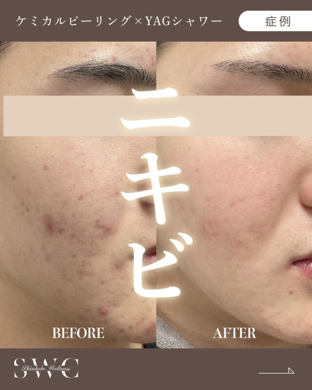.
神戸ウェルネスクリニック美容皮膚科です🕊️

今回は、只今🎊キャンペーン中🎊の
 "ケミカルピーリング✖️YAGシャワー"の
症例をご紹介します✨

【20代】

お悩み：ニキビがなかなか治らない

📸 治療前 → 12回目 の経過をご覧ください😊

【施術リスク】
●赤みや皮剥け：ほぼ1日で落ちついてきます

⚠️症例写真は施術による変化の一例であり、
すべての方に同様の効果を保証するものではありません。

ケミカルピーリングで古い角質をオフ✨
毛穴の詰まりや黒ずみ、ニキビ跡を改善し、
ターンオーバーを促進💆‍♀️
くすみのないスムーズで柔らかな肌へ導きます💖
皮脂の分泌を抑え、ハリや弾力を高めることで
化粧ノリもアップ💄💎

さらにYAGシャワーで
肌のコラーゲン・エラスチン生成をサポート💫
赤ら顔やニキビ跡の赤みをケアしながら、
肌のハリや弾力、小じわも改善✨
肌の水分保持力も高まり、化粧水や美容液の
浸透力がぐんとアップ🫧

この組み合わせだからこそ、
【 透明感・ハリ・ツヤ 】を同時に叶えられる贅沢ケア💎
当院は医師監修のもと施術を行っているので、
安心して肌改善に取り組めます🩺

まずはお気軽に無料カウセリングをご予約ください💐

___________________________________

神戸市中央区北野1-1コトノハコ神戸1F
☎︎ 078-272-0711
市営地下鉄新神戸駅南改札口 徒歩1分
営業時間 9:00-19:00（電話受付9:00-17:00）
ANAクラウンプラザホテル神戸の駐車場ご利用可能
___________________________________

#関西クリニック#兵庫クリニック#美容クリニック#神戸クリニック