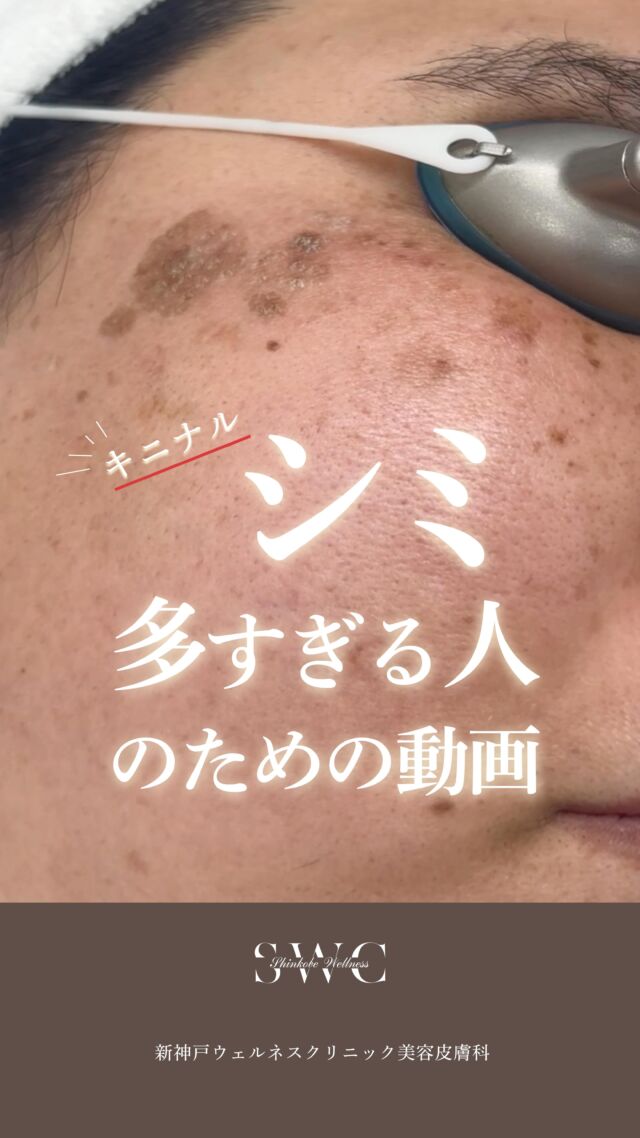 「このシミが最後の1個」
そう思われたのは、何回目でしょうか。

ピコレーザーを用いて、
シミの種類・状態を見極めながら
計画的に治療を行います🔍✨
当院は、シネロン•キャンデラ社のPico Wayを使用してます⭕️

そして大切なのが、治療後のアフターケア🌿

内側からは
💊 シナール
💊 ユベラ
💊 トラネキサム酸

外側からは
🧴 ガウディスキン TAローション
🧴 ガウディスキン HQクリア
🧴 カリグラム ブライトケアライン

内外両面から丁寧にアプローチすることで、
未来のシミを増やさない肌づくりへ✨

まずはお気軽に無料カウセリングをご予約ください💐

___________________________________

神戸市中央区北野1-1コトノハコ神戸1F
☎︎ 078-272-0711
市営地下鉄新神戸駅南改札口 徒歩1分
営業時間 9:00-19:00（電話受付9:00-17:00）
ANAクラウンプラザホテル神戸の駐車場ご利用可能
___________________________________

#神戸クリニック#シミ取り#シミ取りレーザー#ピコレーザー