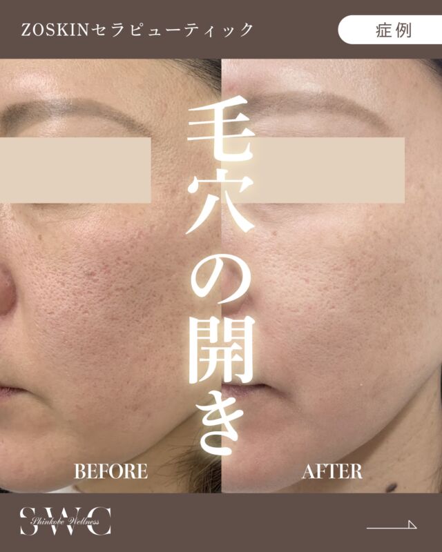 毛穴の開きにお悩みの方も多いはずッ....!!
今回は "ZO SKIN セラピューティック"を
続けて肌改善された方の症例をご紹介します✨

【40代】

お悩み：シミ・毛穴の開き

📸 開始前 → 12週目 の経過をご覧ください☺️
⚠️症例写真は施術による変化の一例であり、
すべての方に同様の効果を保証するものではありません。

一般的な市販化粧品が「一時的な保湿」を目的とするのに
対し、ゼオスキンヘルスは有効成分を肌深部まで届け、
肌本来の機能を細胞レベルから立て直す
医療機関専売スキンケア⭕️

\\✨セラピューティックコース✨//
▶︎▶︎ 料金 : 48920円

【使用した薬剤】
☑︎ハイドラーティングクレンザー
☑︎バランサートナー
☑︎ミラミン
☑︎ミラミックス
☑︎0.1%トレチノイン

約12〜18週間のセラピューティックプログラムでは
▶ 反応期：古い角質をリセット
▶ 耐久期：ハリ・キメが整い始め
▶ 完成期：トラブルのない健やかな肌へ

本気で肌質改善したい方に選ばれる
“攻め”のスキンケアプログラムです🧴✨
※ダウンタイムがある施術です

まずは無料カウセリングでお気軽にご相談ください💐

___________________________________

神戸市中央区北野1-1コトノハコ神戸1F
☎︎ 078-272-0711
市営地下鉄新神戸駅南改札口 徒歩1分
営業時間 9:00-19:00（電話受付9:00-17:00）
ANAクラウンプラザホテル神戸の駐車場ご利用可能
___________________________________

#毛穴の開き#毛穴#zoskinhealth#ゼオスキンセラピューティック#美肌治療