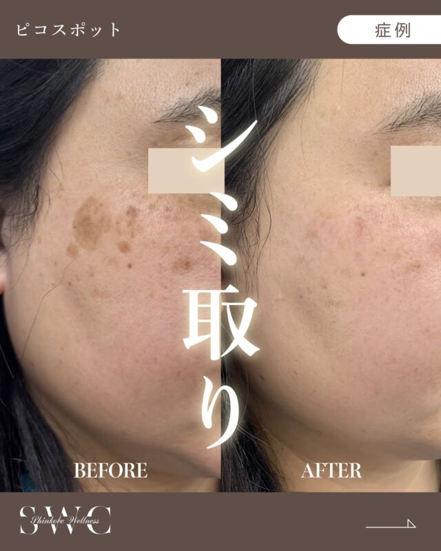 他院で5年前にシミ取りをしたけど、
再発してしまい大きなシミがお悩みのお客様の、
シミレーザー（ピコスポット） の症例のご紹介です🌿✨

5年前のシミ取り後のアフターケアで
紫外線対策を怠ってしまったため再発してしまったとのことです...
しかし、ピコレーザーを当てて4週間でお肌も見違えるほどに✨
ガウディのインナーモイストTAローションとHQクリアを併用されました。

当院では再発しないようにスキンケアや紫外線対策の指導を行なっております✨

📸BEFORE→ AFTERをご覧ください！
治療前の写真では、大きいシミ目立っていましたが…
治療4週間後の写真では、綺麗にかさぶたも剥がれて
お肌も均一でなめらかな印象になりました✨

⚠️症例写真は施術による変化の一例であり、
すべての方に同様の効果を保証するものではありません。

まずはお気軽に無料カウセリングをご予約ください💐

___________________________________

神戸市中央区北野1-1コトノハコ神戸1F
☎︎ 078-272-0711
市営地下鉄新神戸駅南改札口 徒歩1分
営業時間 9:00-19:00（電話受付9:00-17:00）
ANAクラウンプラザホテル神戸の駐車場ご利用可能
___________________________________

#そばかす#シミ#肝斑#ピコスポット#ピコレーザー