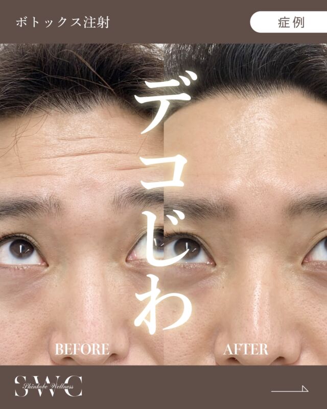 今回は『額ボトックス』の症例のご紹介です💡
📸Before→Afterをご覧ください！

💉ボトックスとは？
筋肉の過剰な動きを抑えることで
✔ 表情ジワの改善（額・眉間・目尻）
✔ 小顔効果（エラの張り）
✔ ワキ汗・においの軽減
などに効果を発揮します。

🧪 当院使用のイノトックス（ボトックス）の特徴
・液状タイプで希釈不要 → 濃度のばらつき・感染リスクを軽減
・ヒト血清アルブミン不使用 → アレルギーや副作用リスクを抑制
・韓国KFDA承認済み → 安全性と有効性が証明済み

⏳ 効果の目安
・2〜14日で効果を実感
・持続期間は3〜6ヶ月程度

まずは無料カウセリングでお気軽にご相談ください✨

___________________________________

神戸市中央区北野1-1コトノハコ神戸1F
☎︎ 078-272-0711
市営地下鉄新神戸駅南改札口 徒歩1分
営業時間 9:00-19:00（電話受付9:00-17:00）
ANAクラウンプラザホテル神戸の駐車場ご利用可能
___________________________________

#肌質改善#美容医療#ボトックス#美容クリニック#美肌