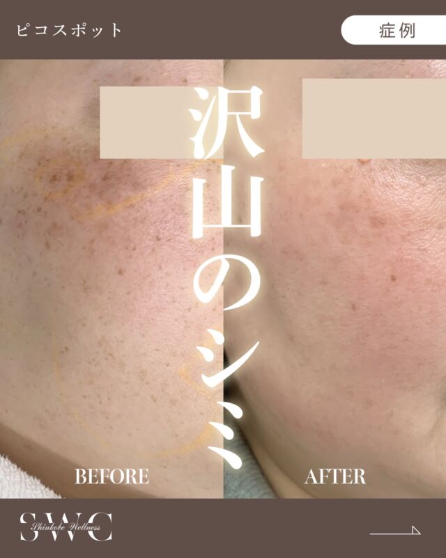 今回はシミ取りをされたお客様の症例です💡

📸BEFORE→2週間後→2ヶ月後の経過をご覧ください！
治療前の写真では、沢山のシミ目立っていましたが…
治療2ヶ月後の写真では、綺麗にかさぶたも剥がれて
シミの数もかなり減り明るい印象になりました✨

⚠️症例写真は施術による変化の一例であり、
すべての方に同様の効果を保証するものではありません。

当院では、シネロン・キャンデラ社製のピコレーザー
👑ピコウェイ👑を使用しております！
紫外線が強くなる夏の前に是非お試しください🙌☀️

まずはお気軽に無料カウセリングをご予約ください💐

___________________________________

神戸市中央区北野1-1 コトノハコ神戸1F
☎︎ 078-272-0711
市営地下鉄 新神戸駅 南改札口 徒歩1分
営業時間 9:00〜19:00（電話受付 9:00〜17:00）
ANAクラウンプラザホテル神戸 駐車場ご利用可能
___________________________________

#ピコレーザー#ピコスポット#しみ#シミ取り