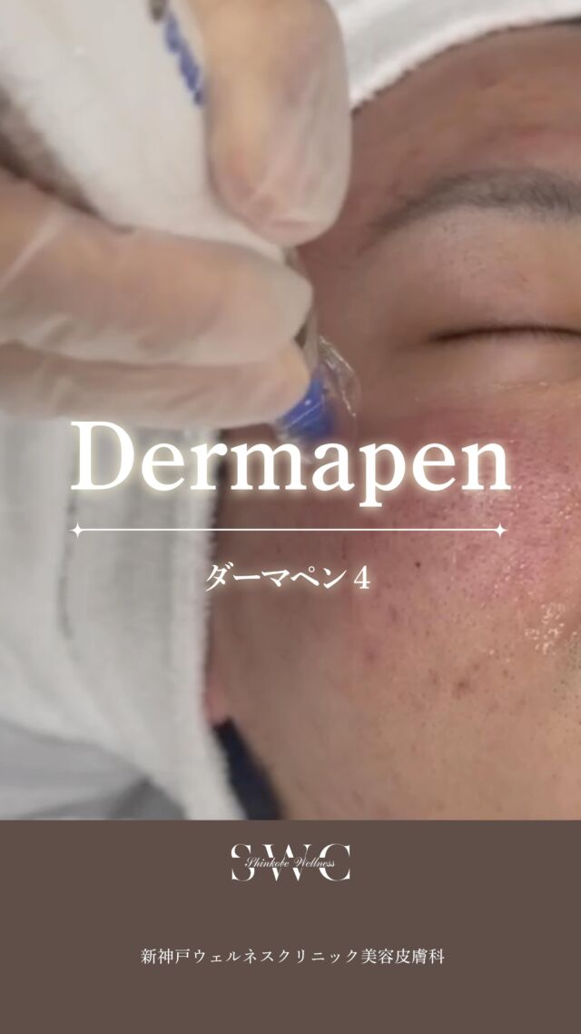 ダーマペン4とは、
髪の毛よりも細い超極細の針で
お肌に微細な穴をつくり、
自然治癒力を引き出す美肌再生施術です✨

先端の16本の針が高速で動き、
1秒間に約1,920個の穴を形成🌿

この刺激により、
コラーゲンやエラスチンの生成をサポートし、
ハリ・弾力のあるお肌へ💆‍♀️

さらにターンオーバーを整え、
なめらかな肌質へ導きます✨

美容成分も浸透しやすくなり、
より効果を実感しやすくなります🌼

こんなに人にオススメ👍‼︎
☑︎ニキビ跡が気になる方
☑︎毛穴を小さくしたい方
☑︎ターンオーバーを促し、新陳代謝を上げたい方
☑︎肌のハリが気になる方

まずは無料カウセリングからお待ちしております💐

___________________________________

神戸市中央区北野1-1コトノハコ神戸1F
☎︎ 078-272-0711
市営地下鉄新神戸駅南改札口 徒歩1分
営業時間 9:00-19:00（電話受付9:00-17:00）
ANAクラウンプラザホテル神戸の駐車場ご利用可能
___________________________________

#ダーマペン#ダーマペン4 #肌質改善