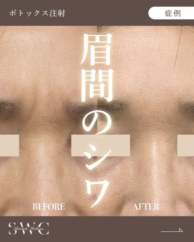 今回は『眉間ボトックス』の症例です💡
📸Before→Afterをご覧ください！

『眉間のボトックス』は、眉間にシワを寄せるクセのある方に向いています✨
放置するとシワが深く刻まれてしまいます💦

ボトックスを注射すると、一時的に眉間にシワを寄せようとしても寄りにくくなります。ボトックス注射を継続する事で、深い縦ジワが刻まれるのを予防することができます⭕️

💉こんなシワが気になる方はボトックス注射が有効です！
✔ 額の横ジワ
✔ 眉間の縦ジワ
✔ 目尻の笑いジワ

☝️これらの"表情ジワ"には
原因となる筋肉に注射することで、筋肉の動きを抑制し、
一定期間シワを改善したり、シワがくっきりと
刻まれるのを予防することができます✨

🧪 当院使用のイノトックス（ボトックス）の特徴
 •約3〜4ヶ月間、効果を実感出来ます
・液状タイプで希釈不要 → 濃度のばらつき・感染リスクを軽減
・ヒト血清アルブミン不使用 → アレルギーや副作用リスクを抑制
・韓国KFDA承認済み → 安全性と有効性が証明済み

まずは無料カウセリングでお気軽にご相談ください✨

___________________________________

神戸市中央区北野1-1コトノハコ神戸1F
☎︎ 078-272-0711
市営地下鉄新神戸駅南改札口 徒歩1分
営業時間 9:00-19:00（電話受付9:00-17:00）
ANAクラウンプラザホテル神戸の駐車場ご利用可能
___________________________________

#肌質改善#美容医療#ボトックス#美容クリニック#美肌