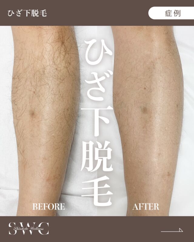 【男性】ひざ下脱毛 の症例をご紹介します✨

BEFORE→AFTERの変化を画像よりご覧ください📸
脱毛前は毛が多く見られましたが、
2回目施術前には毛量が減少し、
生えにくくなっていることが確認できます✨

【施術のリスク】
●ダウンタイム
：一時的な赤みが数日程度続く場合あります。
●リスク
：一時的な赤み・腫れ・ヒリヒリ感、（まれに）軽い火傷や色素沈着、毛周囲の炎症（毛嚢炎）、硬毛化の可能性があります。
※施術のリスクには個人差があります。

まずは無料カウセリングからお待ちしております💐
___________________________________

神戸市中央区北野1-1コトノハコ神戸1F
☎︎ 078-272-0711
市営地下鉄新神戸駅南改札口 徒歩1分
営業時間 9:00-19:00（電話受付9:00-17:00）
ANAクラウンプラザホテル神戸の駐車場ご利用可能
___________________________________

#脱毛#医療脱毛#ジェントルマックスプロ
