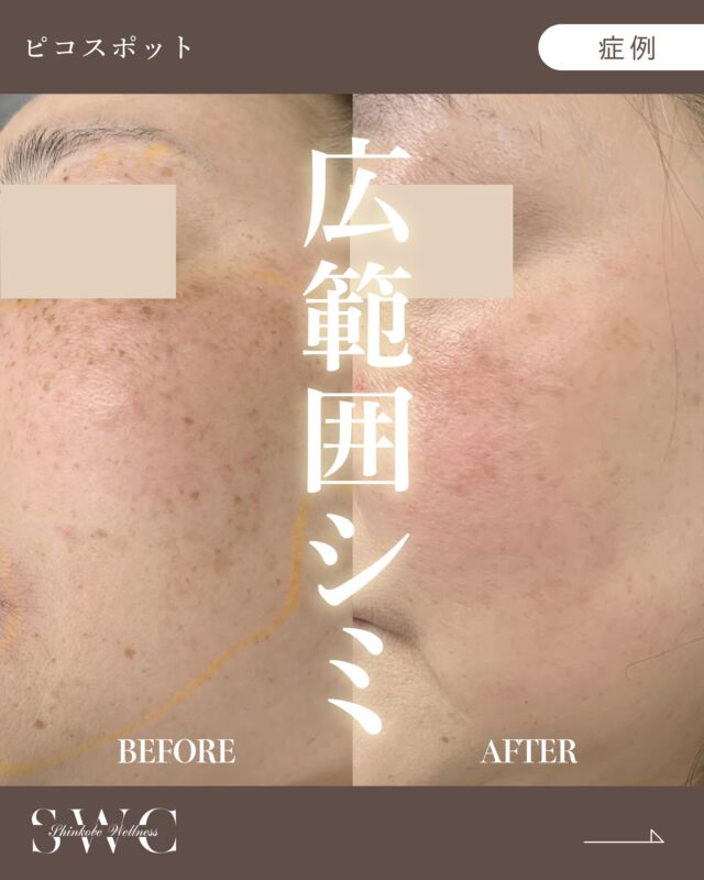 今回は頬全体に散在するシミが気になるお客様の施術症例です💡

📸BEFORE→2ヶ月後の経過をご覧ください！
治療前の写真では、沢山のシミ目立っていましたが…
治療2ヶ月後の写真では、シミの数がかなり減り明るい印象になりました✨

⚠️症例写真は施術による変化の一例であり、
すべての方に同様の効果を保証するものではありません。

当院では、シネロン・キャンデラ社製のピコレーザー
👑ピコウェイ👑を使用しております！
紫外線が強くなる夏の前に是非お試しください🙌☀️

まずはお気軽に無料カウセリングをご予約ください💐

___________________________________

神戸市中央区北野1-1 コトノハコ神戸1F
☎︎ 078-272-0711
市営地下鉄 新神戸駅 南改札口 徒歩1分
営業時間 9:00〜19:00（電話受付 9:00〜17:00）
ANAクラウンプラザホテル神戸 駐車場ご利用可能
___________________________________

#ピコレーザー#ピコスポット#しみ#シミ取り
