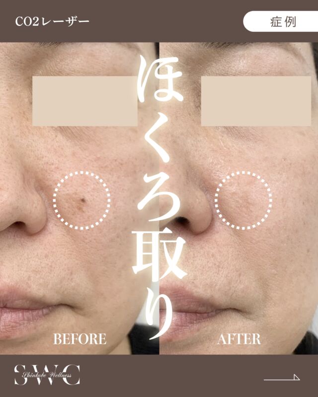 .
今回は【 ほくろ除去の症例 】をご紹介します✨

こちらの方は、
『左鼻横のほくろ』でお悩みでした。

CO2レーザーを使用し、
1回で1か所（¥5,000） の治療を行いました💡
こちらの女性は麻酔を使用したので、
麻酔注射時のチクッとした痛みだけで
ほくろを取ることが出来ました🙌

📸 治療前 → 2週間後 → 4ヶ月後の経過をご覧ください！
丁寧に除去したので、4ヶ月後には傷跡も目立たない自然で美しい仕上がりを実現しています。

ほくろの大きさや状態によっては除去できない
場合もございますので、お悩みのかたはまずは
お気軽にご相談ください🕊️

ご相談・ご予約はプロフィール下のリンクから
お待ちしております💐

___________________________________

神戸市中央区北野1-1コトノハコ神戸1F
☎︎ 2078-272-0711
市営地下鉄新神戸駅南改札口 徒歩1分
営業時間 9:00-19:00（電話受付9:00-17:00）
ANAクラウンプラザホテル神戸の駐車場ご利用可能
___________________________________

#ほくろ取り#co2laser #肌治療#美容クリニック