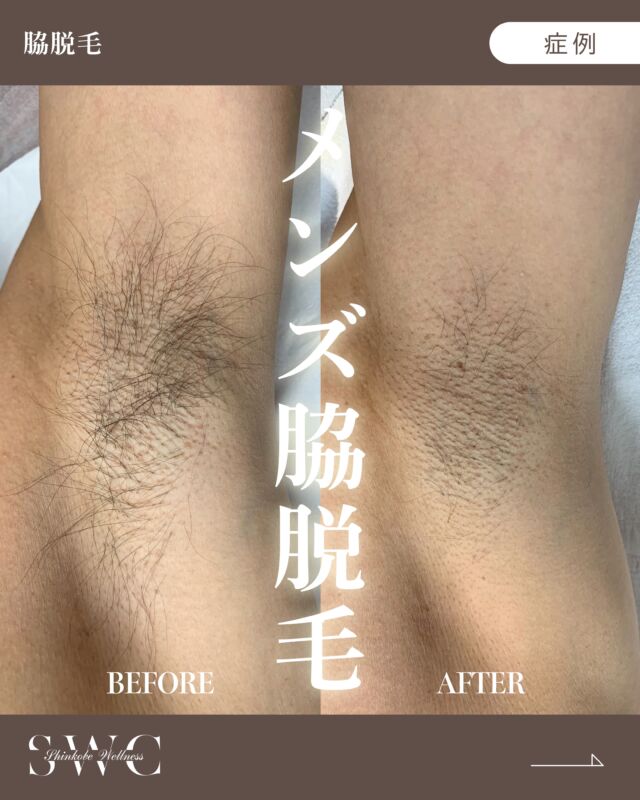 【男性】脇脱毛 の症例をご紹介します✨

BEFORE→AFTERの変化を画像よりご覧ください📸
脱毛前は毛が多く見られましたが、
3回目施術前には毛量が減少し、
生えにくくなっていることが確認できます✨

【施術の副作用】
●ダウンタイム
：一時的な赤みが数日程度続く場合あります。
●リスク
：一時的な赤み・腫れ・ヒリヒリ感、（まれに）軽い火傷や色素沈着、毛周囲の炎症（毛嚢炎）、硬毛化の可能性があります。
※施術のリスクには個人差があります。

まずは無料カウセリングからお待ちしております💐
___________________________________

神戸市中央区北野1-1コトノハコ神戸1F
☎︎ 078-272-0711
市営地下鉄新神戸駅南改札口 徒歩1分
営業時間 9:00-19:00（電話受付9:00-17:00）
ANAクラウンプラザホテル神戸の駐車場ご利用可能
___________________________________

#脱毛#医療脱毛#ジェントルマックスプロ#脇脱毛