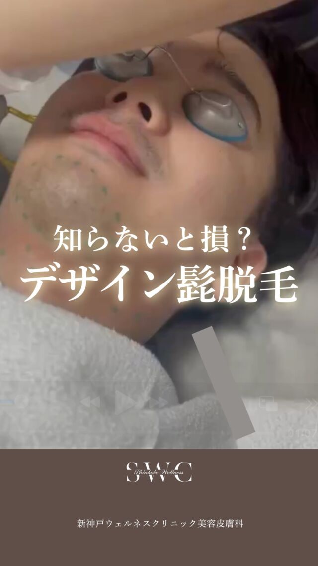 「残したい箇所は残したいけど周りは脱毛したい...」
そんなデザイン髭脱毛考えている方💡
デザイン髭脱毛時のご来店から施術終了までの流れを
動画をみてご確認ください✨

SWCの医療脱毛は、厚労省＆FDA承認の
ジェントルマンマックスプロ2台に加え、
最新機器ジェントルマックスプロ プラスを1台を導入しています！

✔️ 2種類のレーザーであらゆる毛質にも色黒肌にも対応
✔️ 毛母細胞を破壊する熱破壊式脱毛
✔️ 痛みを抑える冷却システム
✔️ 大口径でスピーディー

こんな方におすすめ💡
・永久脱毛したい
・太い毛〜うぶ毛までしっかり脱毛したい
・色黒肌でも安心して脱毛したい
・脱毛＋美白・美肌も叶えたい

※麻酔について
痛みが強い部位は麻酔使用可能です✨
心配な方はご利用ください♪

お気軽に無料カウセリングからお待ちしております💐

___________________________________

神戸市中央区北野1-1コトノハコ神戸1F
☎︎ 078-272-0711
市営地下鉄新神戸駅南改札口 徒歩1分
営業時間 9:00-19:00（電話受付9:00-17:00）
ANAクラウンプラザホテル神戸の駐車場ご利用可能
___________________________________

#脱毛#ヒゲ脱毛#デザイン脱毛#ジェントルマックスプロプラス