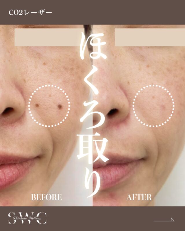 .
今回は【 CO2レーザーの症例 】をご紹介します✨

こちらの方は、
『複数のほくろ』でお悩みでした。

CO2レーザーを使用し、
1回で6か所（¥30,000） の治療を行いました💡
こちらの女性は麻酔を使用したので、
麻酔注射時のチクッとした痛みだけで
ほくろを取ることが出来ました🙌

📸 治療前 → 6ヶ月後の経過をご覧ください！
丁寧に除去したので、傷跡も目立たない自然で美しい仕上がりを実現しています。

ほくろの大きさや状態によっては除去できない
場合もございますので、お悩みのかたはまずは
お気軽にご相談ください🕊️

ご相談・ご予約はプロフィール下のリンクから
お待ちしております💐

___________________________________

神戸市中央区北野1-1コトノハコ神戸1F
☎︎ 2078-272-0711
市営地下鉄新神戸駅南改札口 徒歩1分
営業時間 9:00-19:00（電話受付9:00-17:00）
ANAクラウンプラザホテル神戸の駐車場ご利用可能
___________________________________

#ほくろ取り#co2laser #肌治療#美容医療